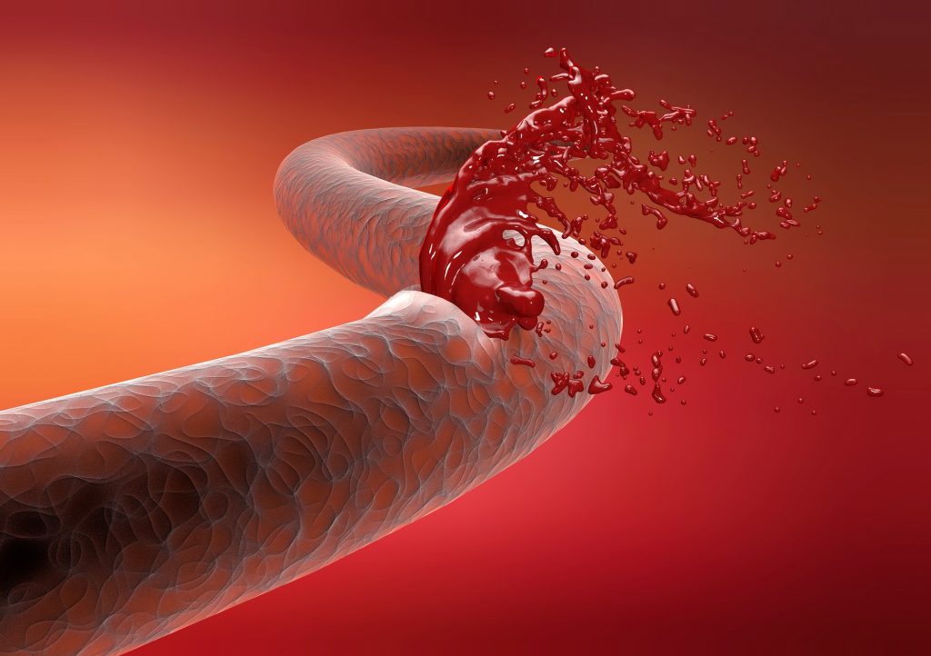 Trauma vascular: tudo que você precisa saber sobre esse perigo