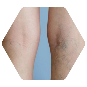 escleroterapia san angelo